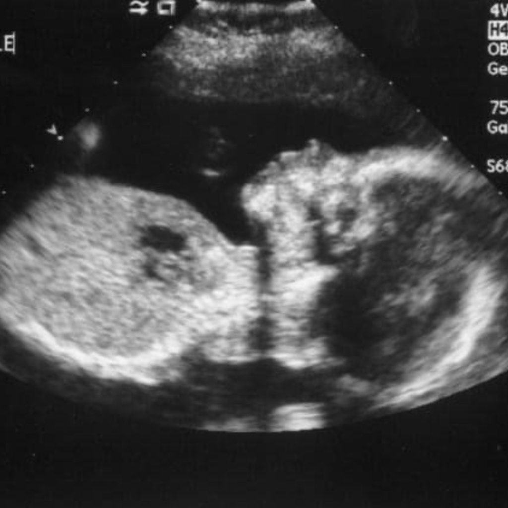 Image of 20 week ultrasound